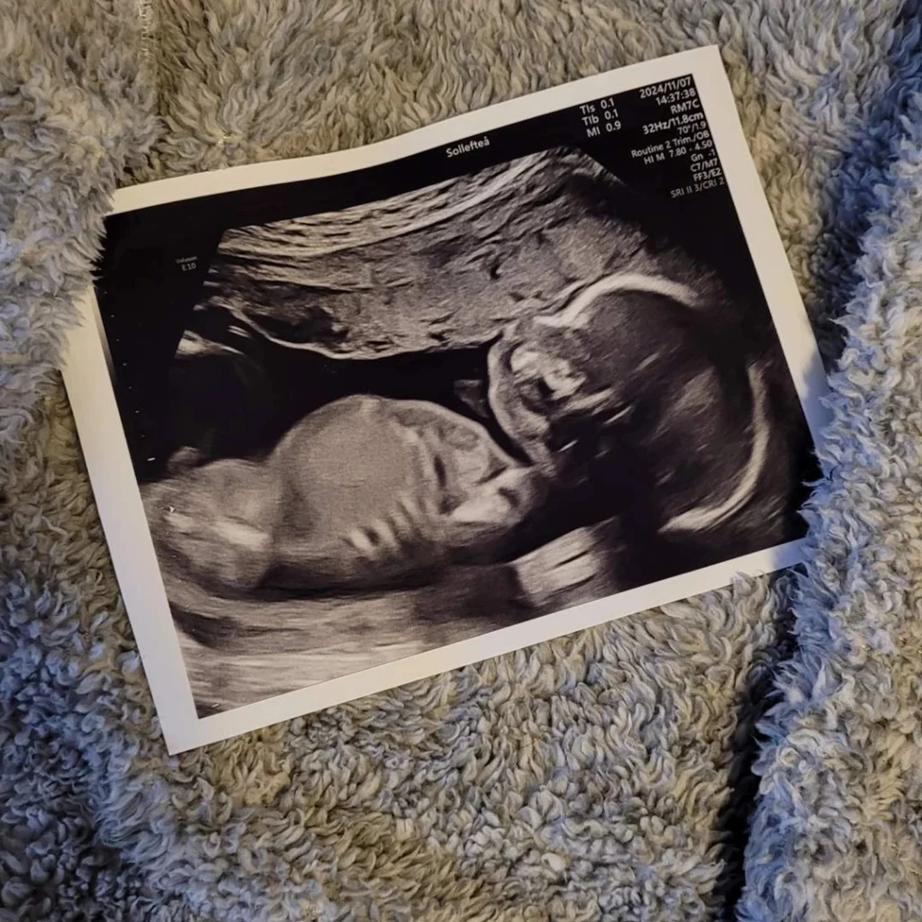 Ett ultraljud av ett foster